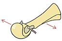 Chevron osteotomie: opschuiven en vastzetten van het kopje van het middenvoetsbeentje.