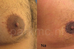 gynaecomastie_voor_na_4