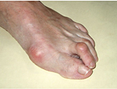 hallux_3_klein