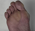 hallux_4_klein