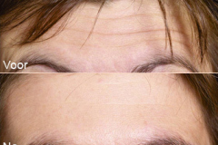 botoxbehandeling_04