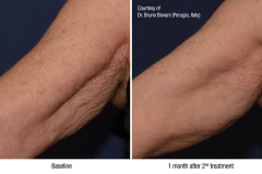 Profhilo_binnenkant_arm