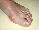 Hallux valgus met hamerteen