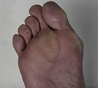 Hallux valgus met voorvoetpijn