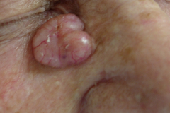 bcc-nodulair1