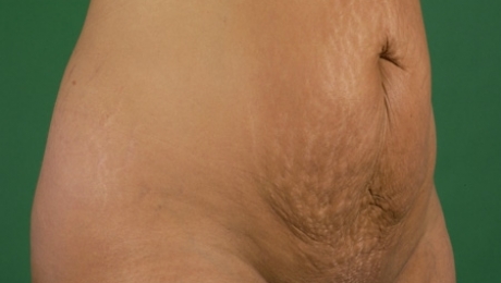 plastisch chirurgie buik plastisch chirurgie buik