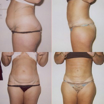 liposuctie onderbuik