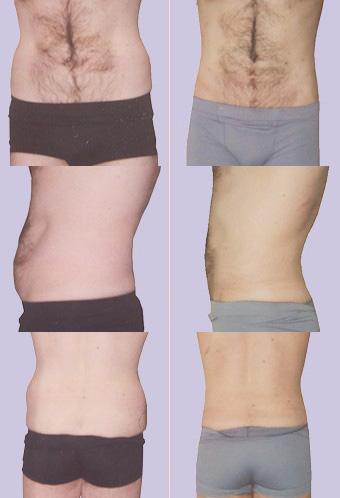 liposuctie kuiten enkels
