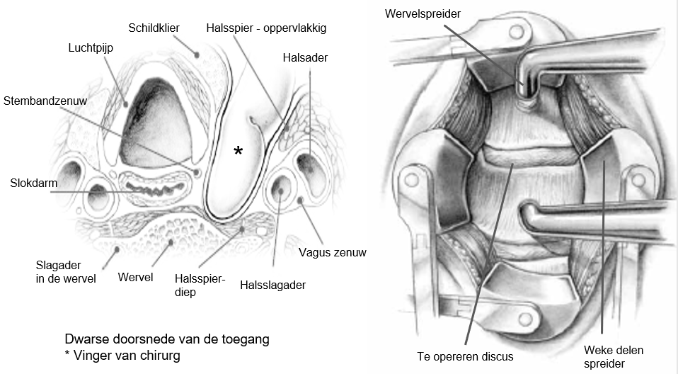 nekhernia