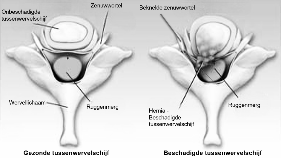 nekhernia