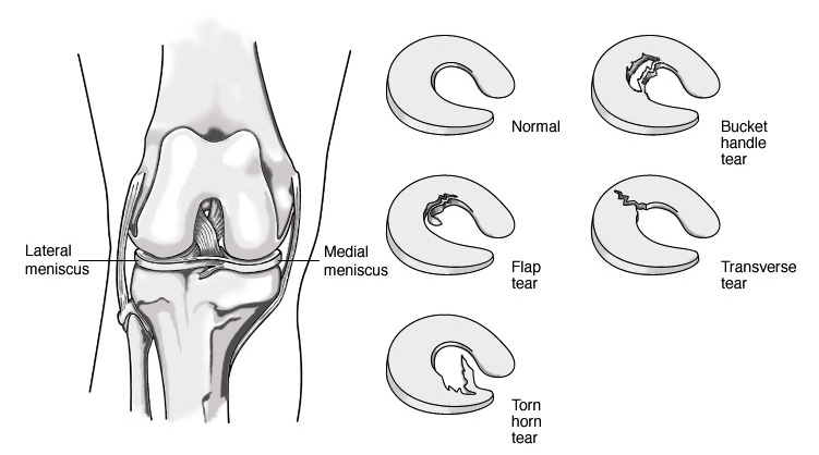 verschillende soorten scheuren meniscus